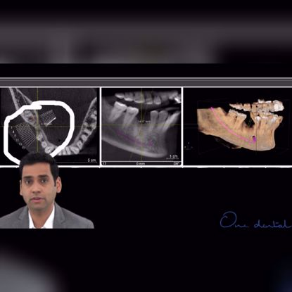Picture of How to read a CBCT to plan implants