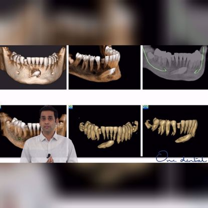 Picture of How to study impacted teeth on a CBCT