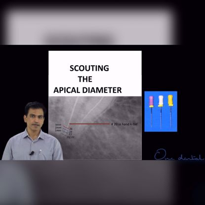 Picture of Scouting the apical diameter