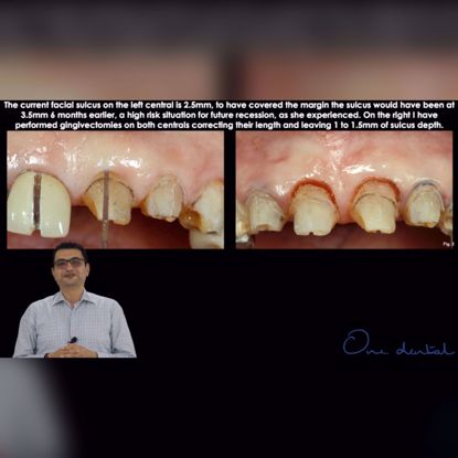 Picture of How to place subgingival margins in a deep sulcus part 1
