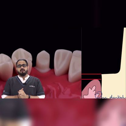 Picture of Margin placement with respect to gingival crest