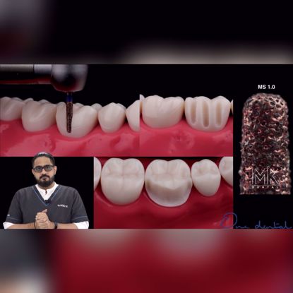 Picture of Making sense of finish lines in prosthodontics