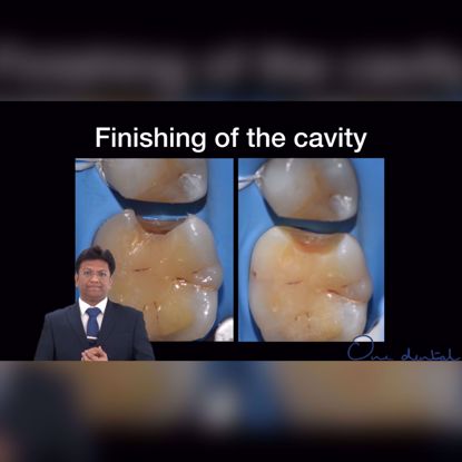 Picture of How much do we need to prepare the cavity?
