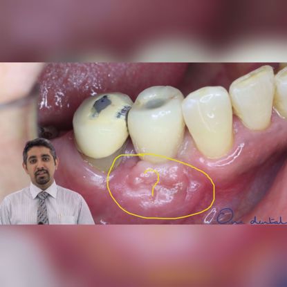 Picture of Is keratinized tissue around dental implants important?