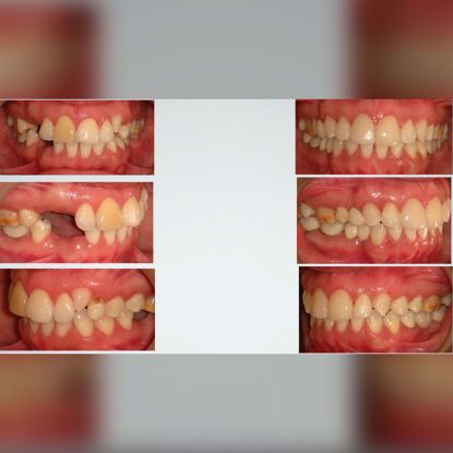 Picture of Functional smile design