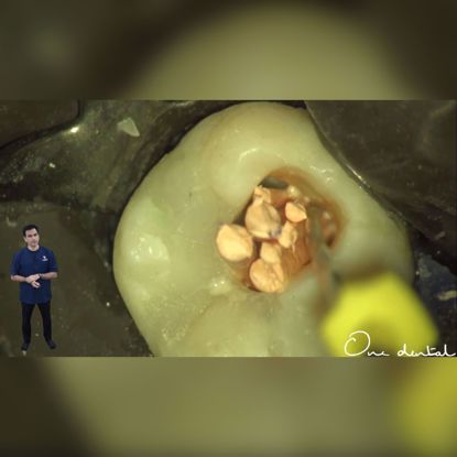Picture of In tooth demonstration of obturation of a mandibular second molar