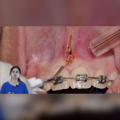 Picture of Laser frenectomy- Step by step