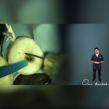 Picture of In tooth simulation of cleaning and shaping a mandibular 2nd premolar