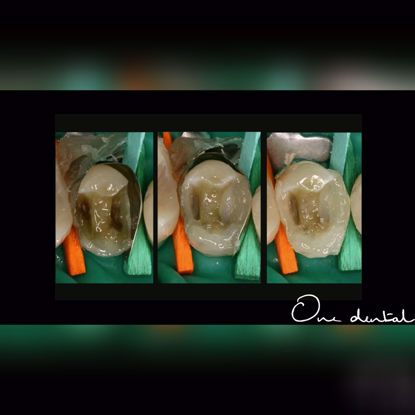 Picture of Direct posterior resin restorations
