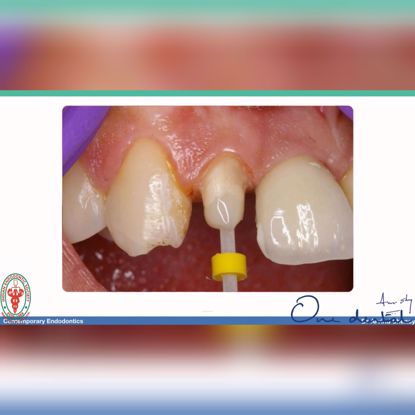 Picture of Post endodontic restorations