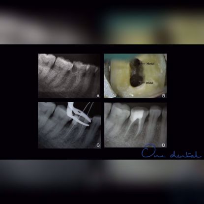 Picture of Aberrant root canal systems