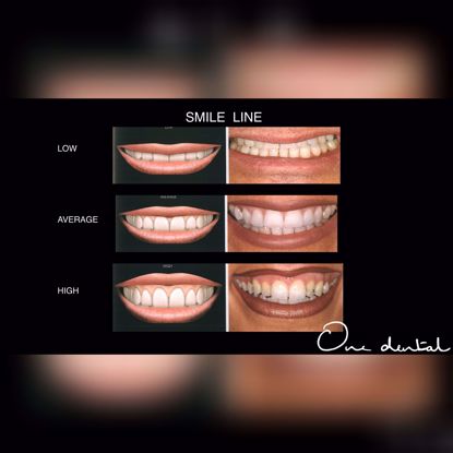 Picture of Demystifying smile designing