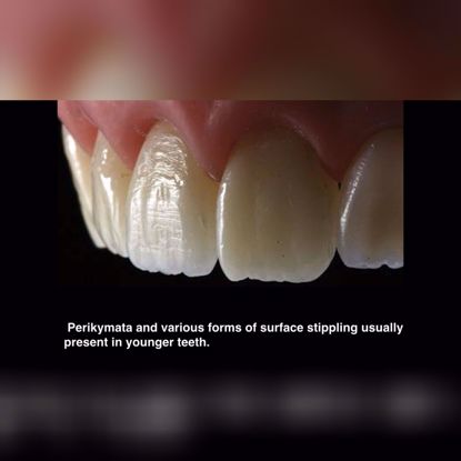 Picture of 7 tips for highly effective composite restorations