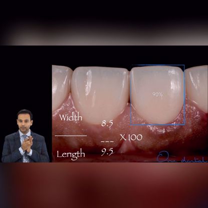 Picture of Understanding tooth proportions