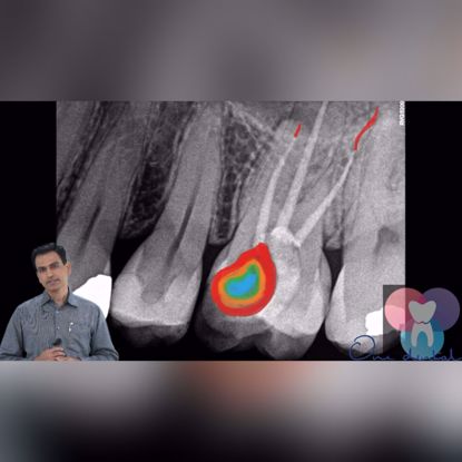Picture of Step by step re-root canal demonstration
