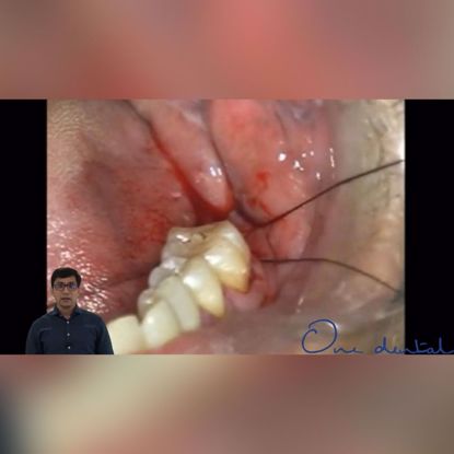 Picture of Use of lasers in peri-implantitis