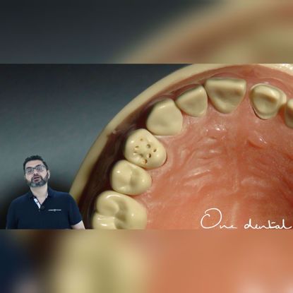 Picture of Detailed demonstration of tooth preparation of a premolar