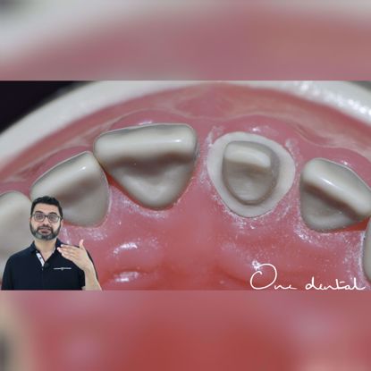 Picture of Detailed demonstration of tooth preparation of an incisor for full ceramic crown