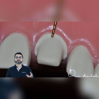 Picture of Detailed demonstration of tooth preparation of an incisor for a PFM crown