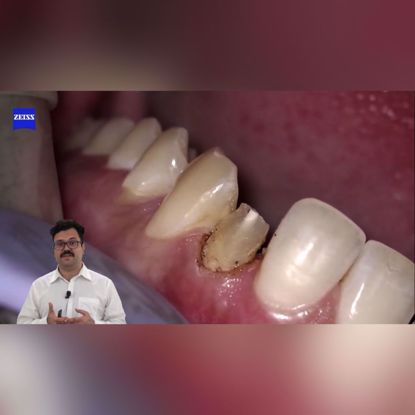 Picture of Importance of magnification in dentistry