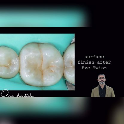 Picture of Finishing and polishing protocol for posterior composite restorations
