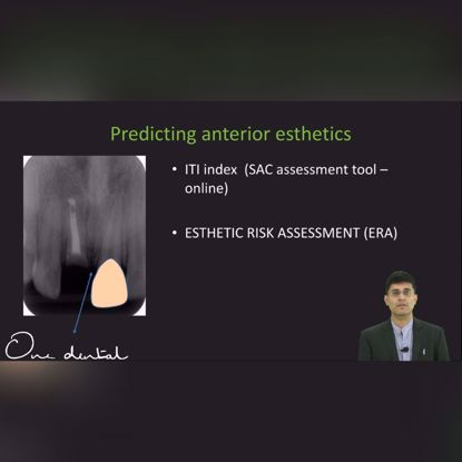 Picture of Esthetic risk assessment in implants