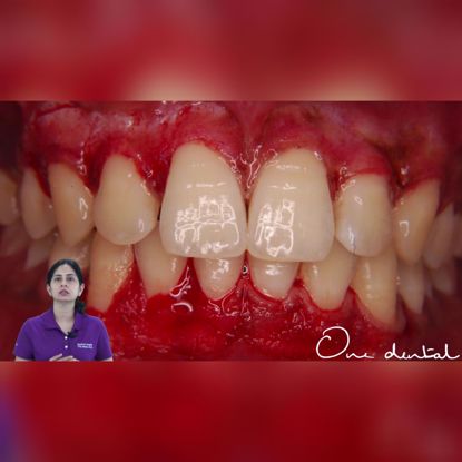 Picture of Gingival depigmentation by surgical stripping