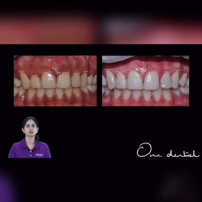 Picture of Gingival depigmentation using diode laser