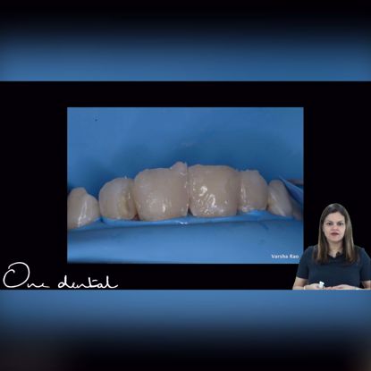 Picture of Modified putty index technique for anterior restorations