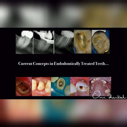 Picture of Current concepts in endodontically treated teeth
