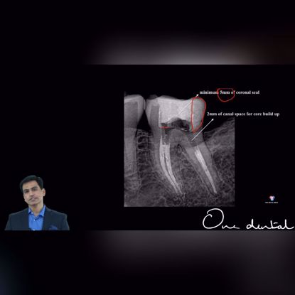 Picture of Pre-endodontic build-up