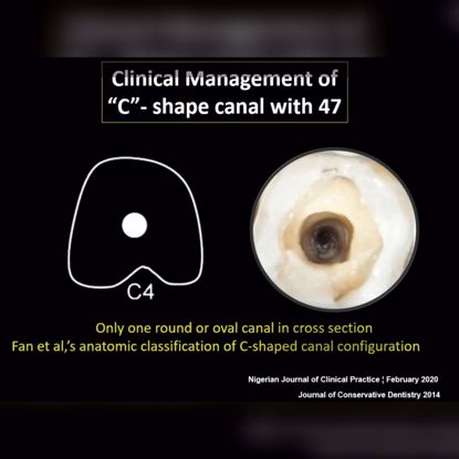 Picture of C-shaped canals: Diagnosis and Management