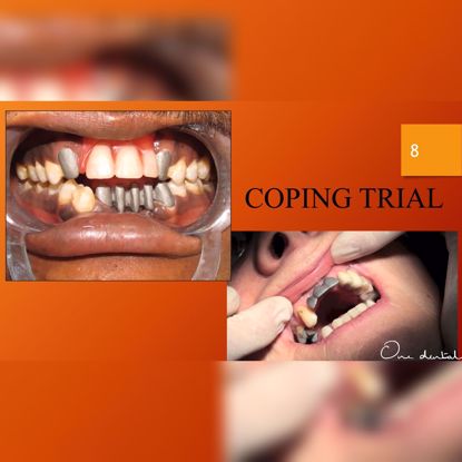 Picture of Coping trial for prosthesis