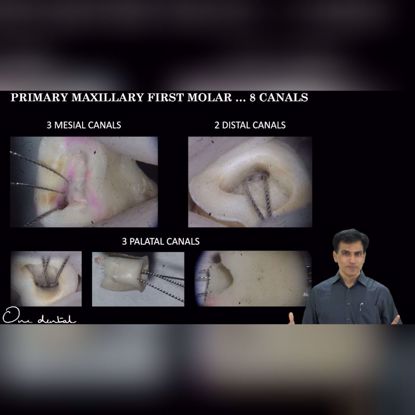 Picture of Variations in maxillary first molar