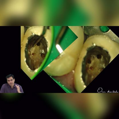 Picture of Endodontic mishap  and its management: Lateral wall perforation