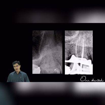 Picture of MB2 in other than maxillary first molar