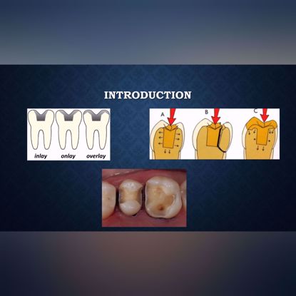 Picture of Preparation of intracoronal restorations