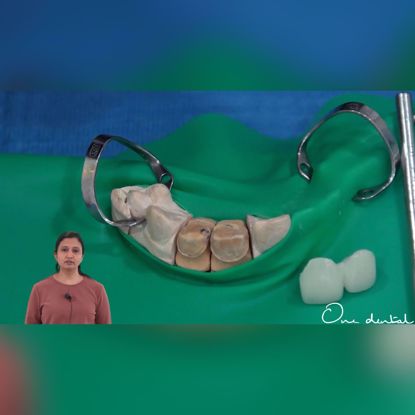 Picture of Cementation of zirconia prosthesis