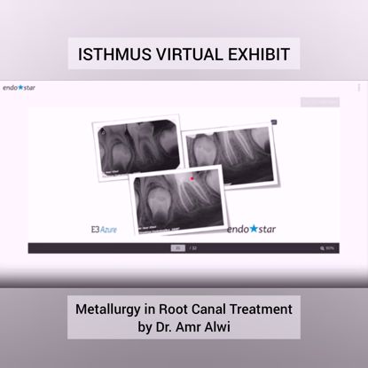 Picture of ISTHMUS VIRTUAL EXHIBIT: Metallurgy in Root Canal Treatment