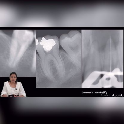 Picture of Etiology to treatment: Symptomatic apical periodontitis