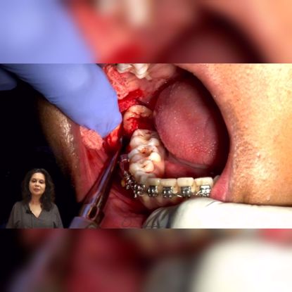 Picture of Surgical extraction of mandibular impacted third molar