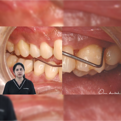 Picture of Comparative approches to dental infection with and without antibiotics